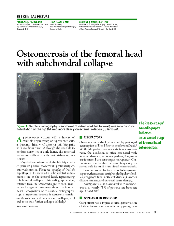 (PDF) Osteonecrosis of the femoral head with subchondral collapse