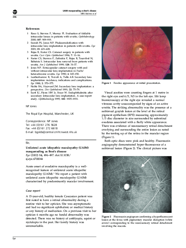 (PDF) Unilateral acute idiopathic maculopathy (UAIM) masquerading as ...