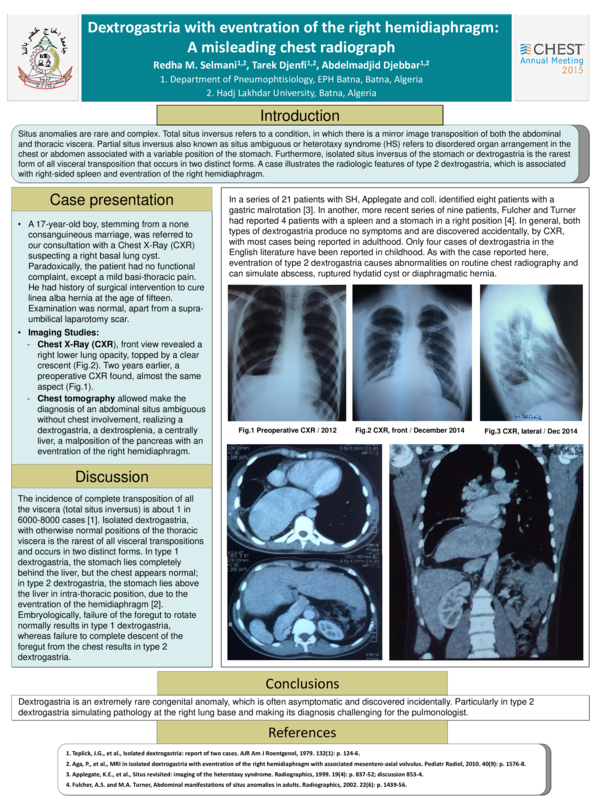 (PDF) Dextrogastria With Eventration of the Right Hemidiaphragm: A ...