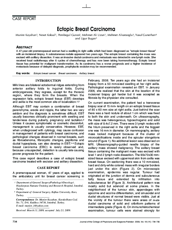 (PDF) Ectopic breast carcinoma