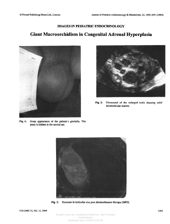 (PDF) Giant Macroorchidism in Congenital Adrenal Hyperplasia
