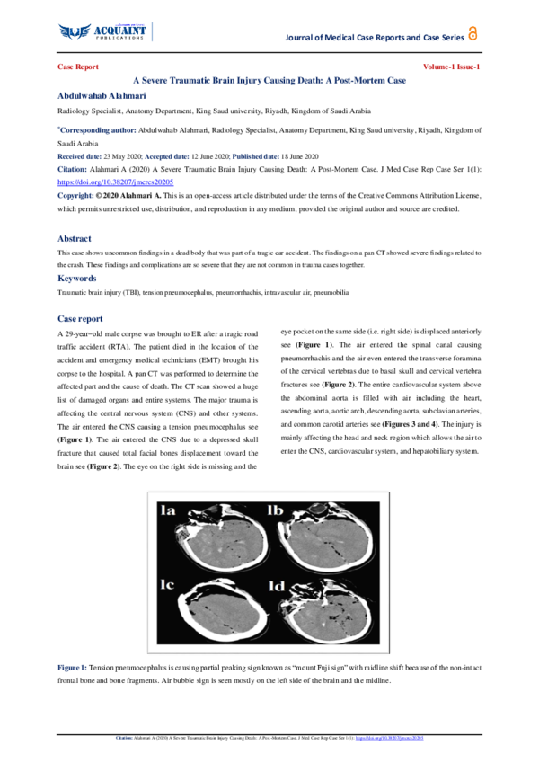 (PDF) A Severe Traumatic Brain Injury Causing Death: A Post-Mortem Case
