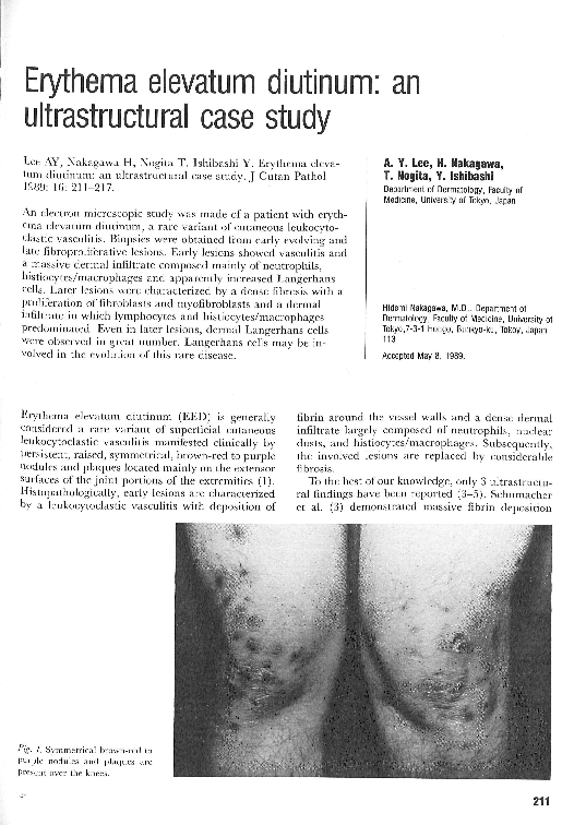 (PDF) Eythema elevatum diutinum: an ultrastructural case study ...