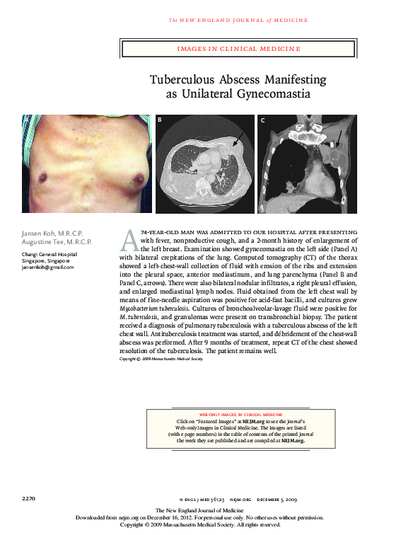(PDF) Tuberculous Abscess Manifesting as Unilateral Gynecomastia