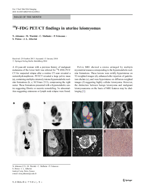 (PDF) 18F-FDG PET/CT findings in uterine leiomyomas