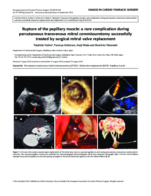 (PDF) Rupture of the papillary muscle: a rare complication during ...