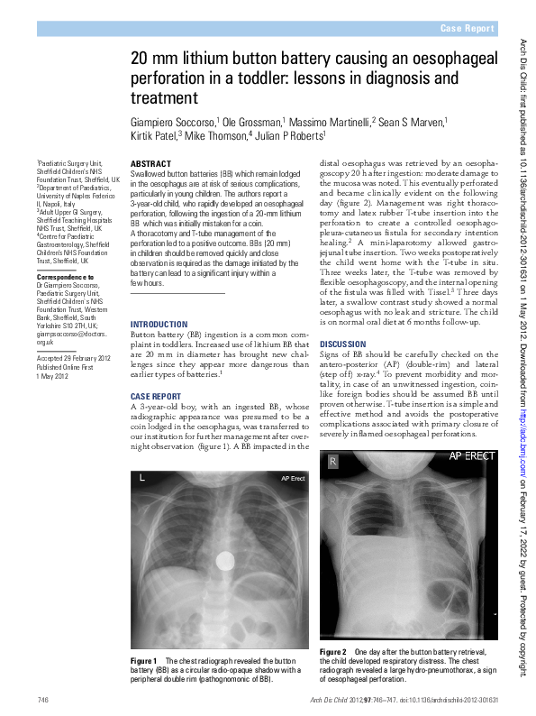 (PDF) 20 MM Lithium Button Battery Causing an Oesophageal Perforation ...