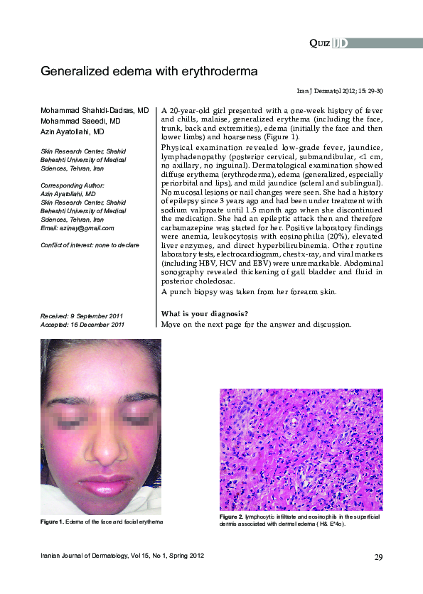 (PDF) Generalized edema with erythroderma