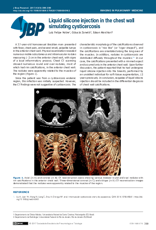 (PDF) Liquid silicone injection in the chest wall simulating cysticercosis