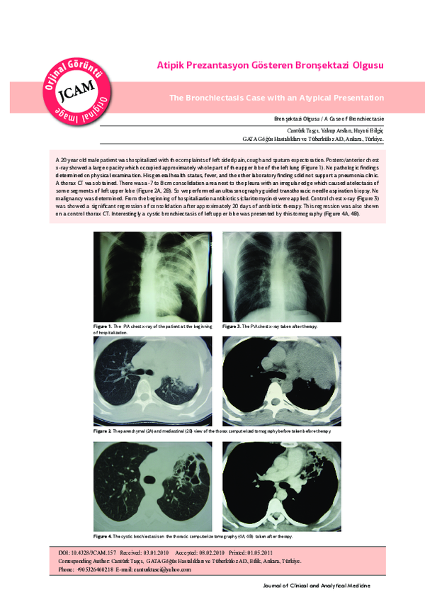 (PDF) The Bronchiectasis Case with An Atypical Presentation