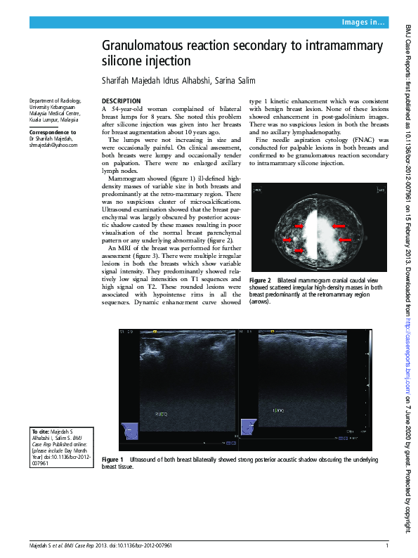 (PDF) Granulomatous reaction secondary to intramammary silicone injection