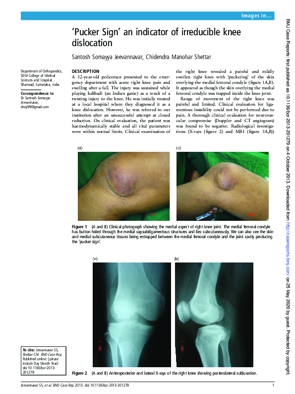(PDF) Pucker Sign' an indicator of irreducible knee dislocation