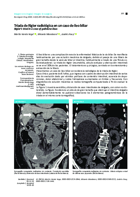 (PDF) Tríada de Rigler radiológica en un caso de íleo biliar