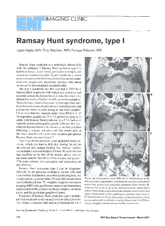 (PDF) Ramsay Hunt Syndrome, Type I