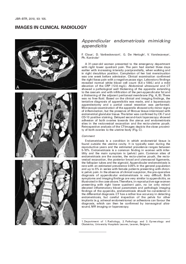 (PDF) Appendicular endometriosis mimicking appendicitis