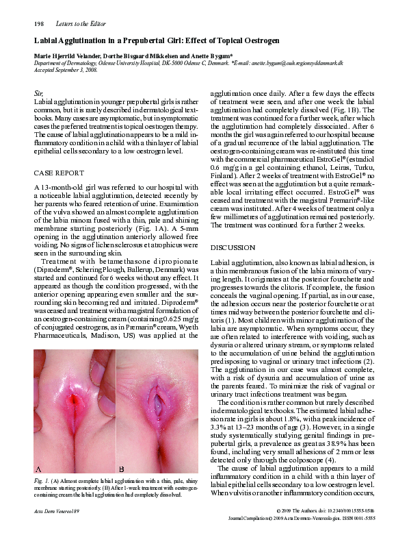 (PDF) Labial agglutination in a prepubertal girl: effect of topical ...