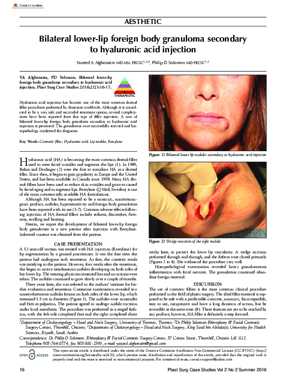 (PDF) Bilateral Lower-Lip Foreign Body Granuloma Secondary to ...