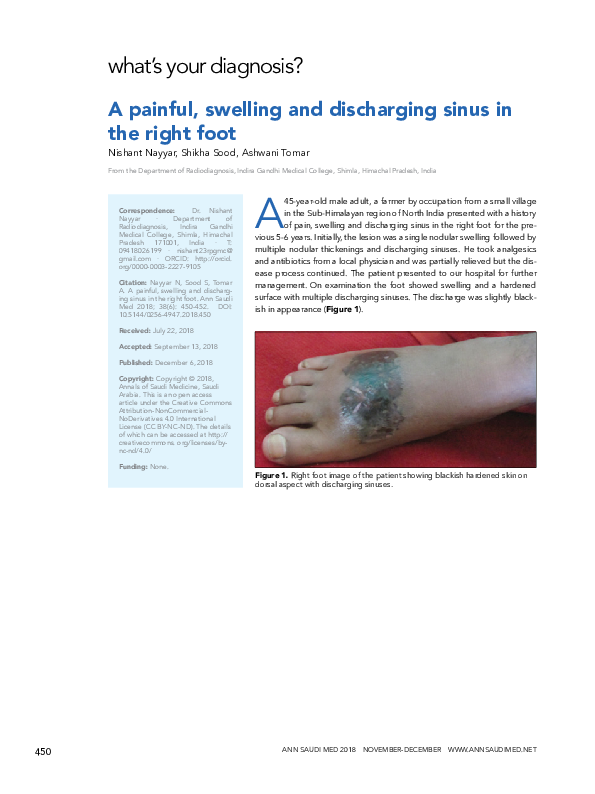 (PDF) A painful, swelling and discharging sinus in the right foot