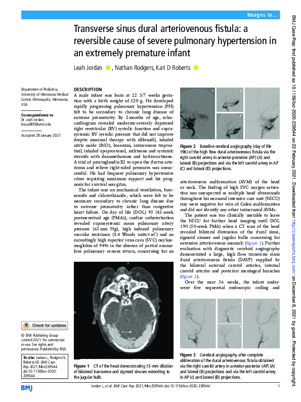 pdf-transverse-sinus-dural-arteriovenous-fistula-a-reversible-cause