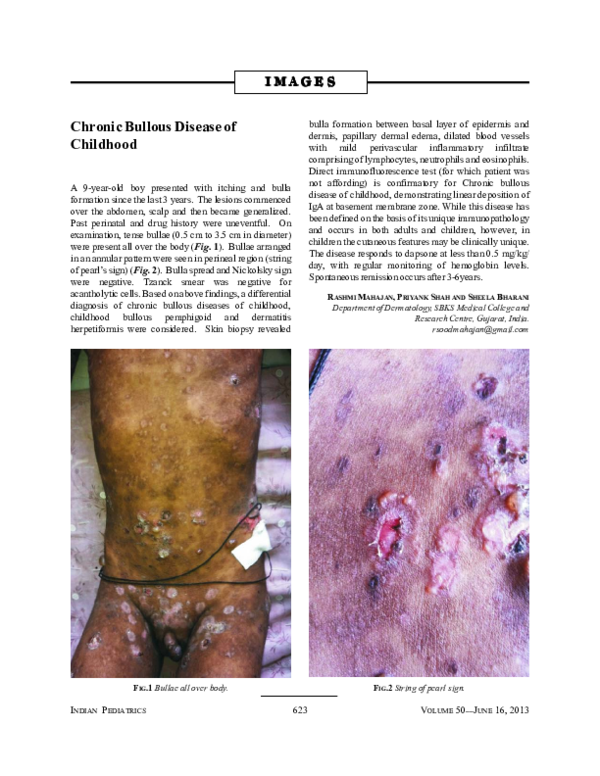(PDF) Chronic bullous disease of childhood