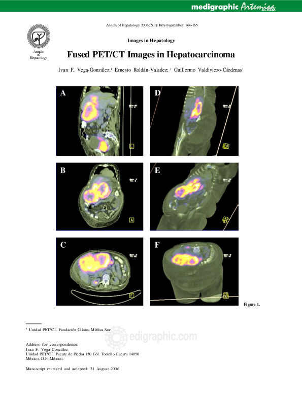 (PDF) Fused PET/CT Images in Hepatocarcinoma