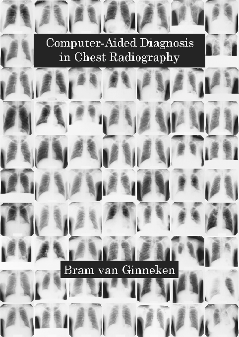 (PDF) Computer aided diagnosis in chest radiography