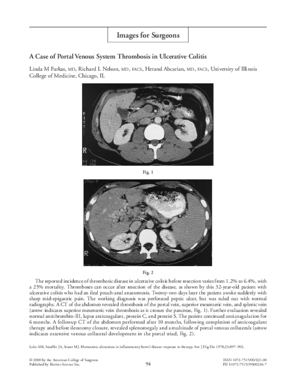 (PDF) A case of portal venous system thrombosis in ulcerative colitis