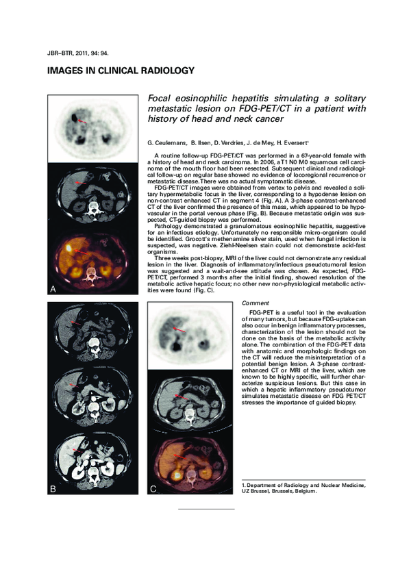 (PDF) Focal eosinophilic hepatitis simulating a solitary metastatic ...