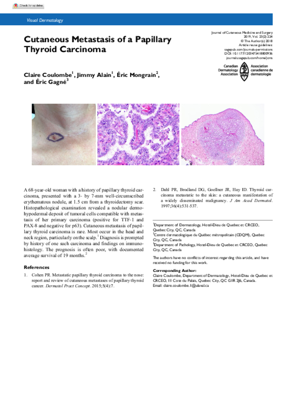 (PDF) Cutaneous metastasis of papillary thyroid carcinoma after total ...