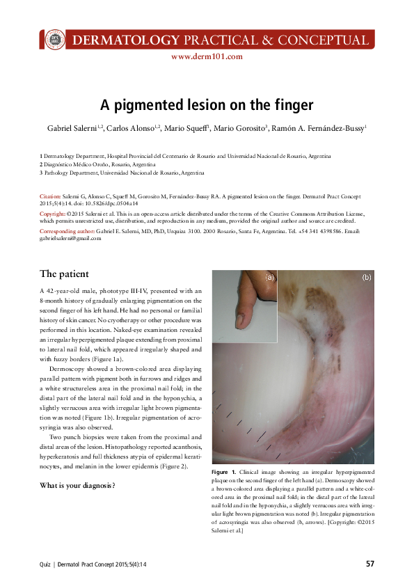 (PDF) A pigmented lesion on the finger
