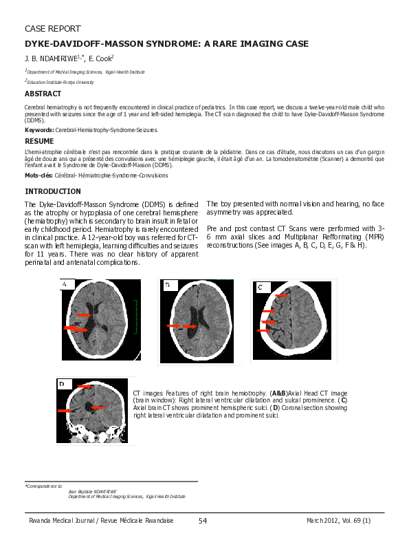 (PDF) Dyke-Davidoff-Masson Syndrome: A Rare Imaging Case