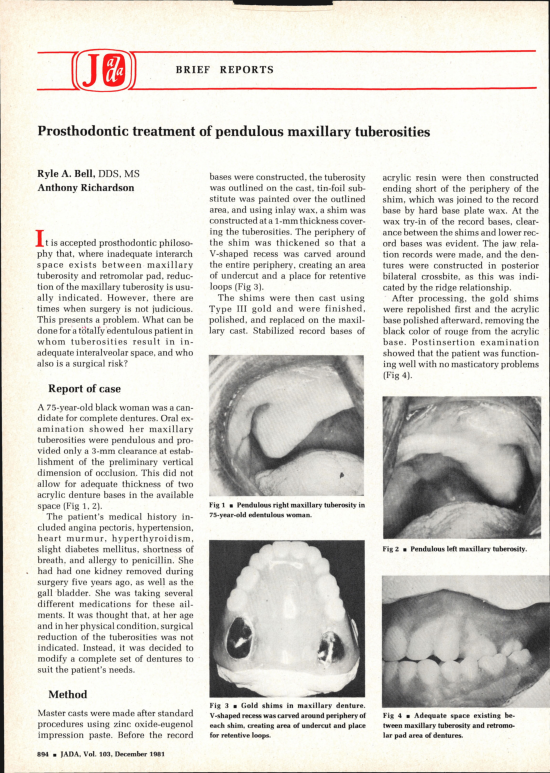 (PDF) Prosthodontic Treatment of Pendulous Maxillary Tuberosities