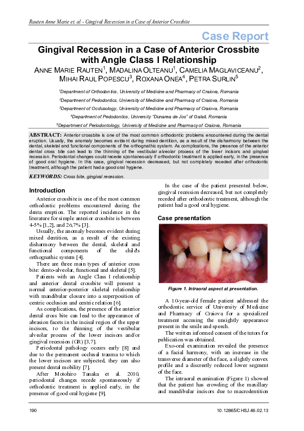 (PDF) Gingival Recession in a Case of Anterior Crossbite with Angle ...
