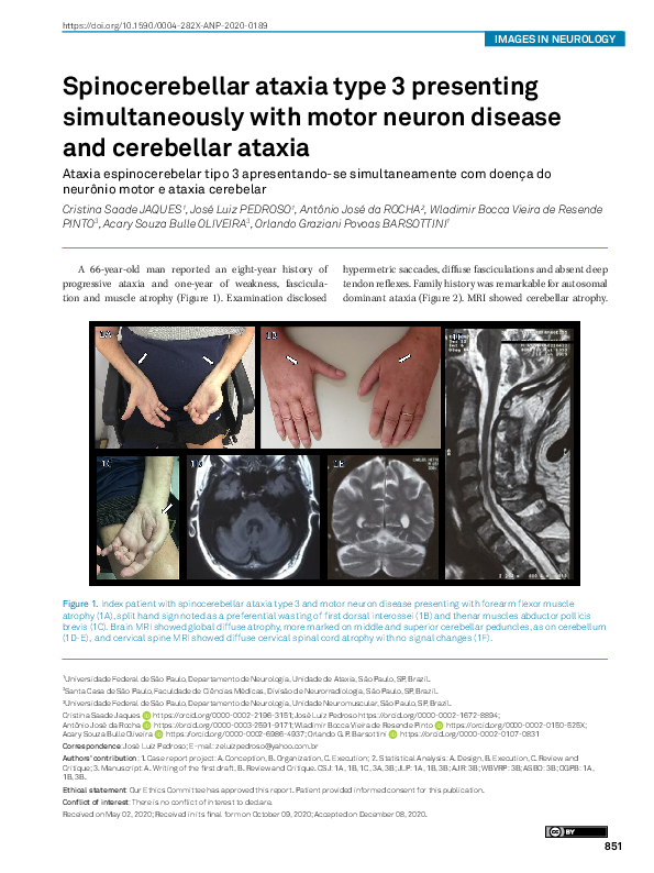 (PDF) Spinocerebellar ataxia type 3 presenting simultaneously with ...