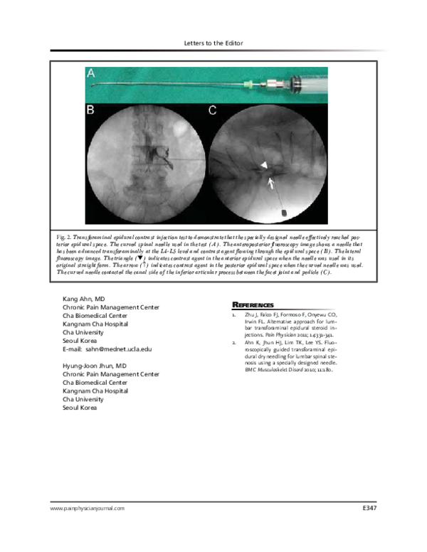 (PDF) CT-Guided Transforaminal Epidural Injections with Local ...