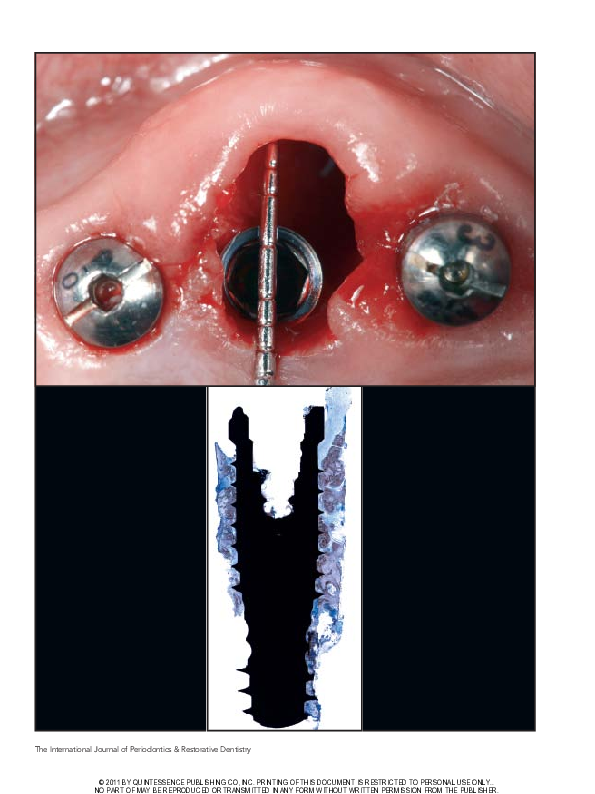 (PDF) Human histologic verification of osseointegration of an immediate ...