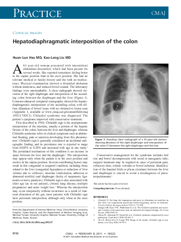 (PDF) Hepatodiaphragmatic interposition of the colon
