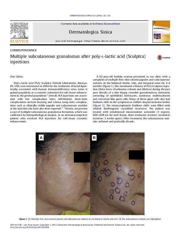 (PDF) Multiple subcutaneous granulomas after poly-l-lactic acid ...