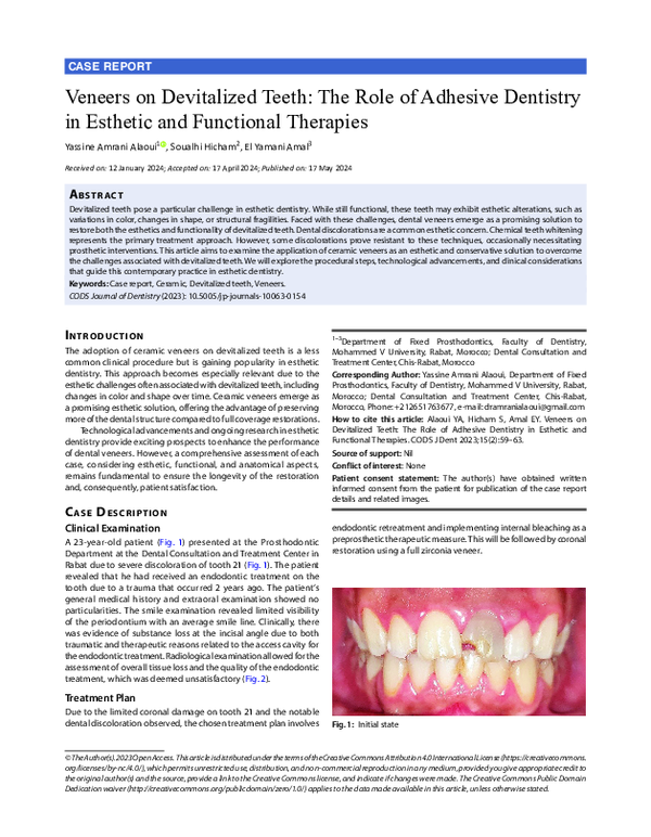 (PDF) Veneers on Devitalized Teeth: The Role of Adhesive Dentistry in ...