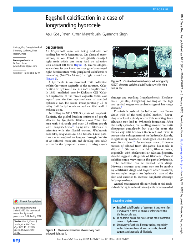 (PDF) Eggshell calcification in a case of longstanding hydrocele