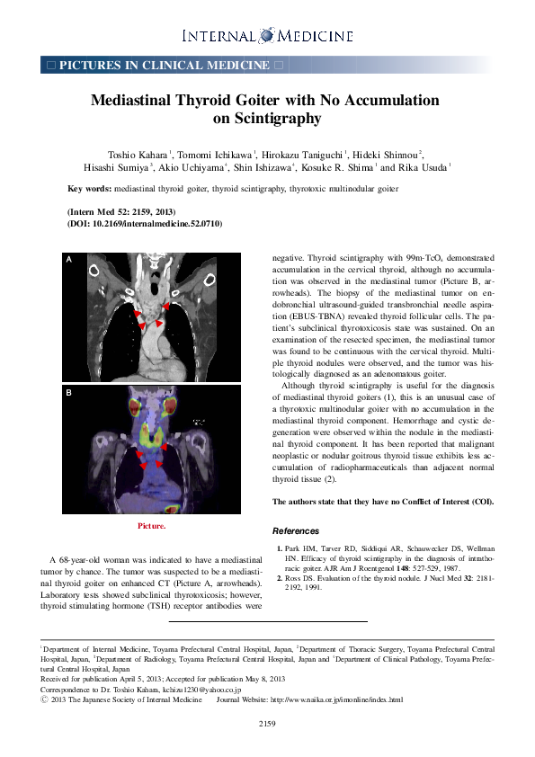 (PDF) Mediastinal Thyroid Goiter with No Accumulation on Scintigraphy