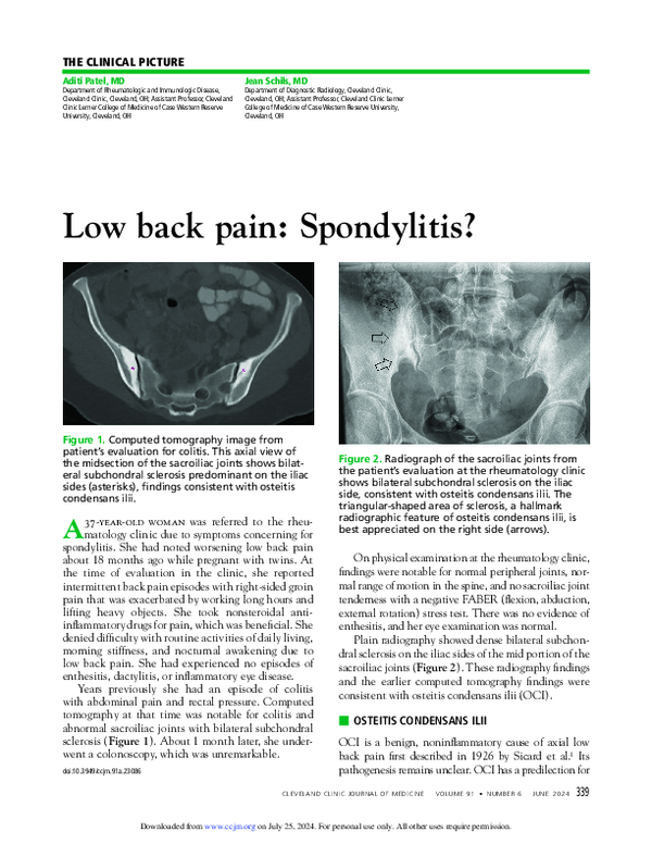 (PDF) Low back pain: Spondylitis?