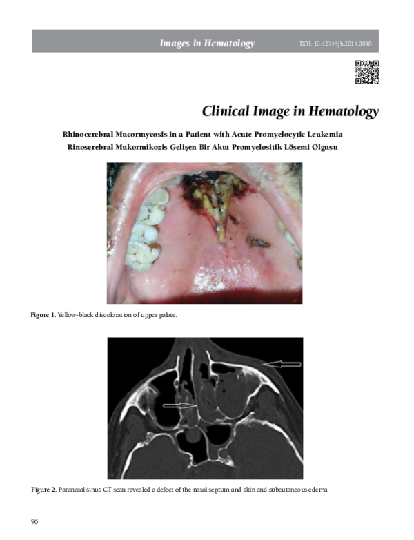 (PDF) Rhinocerebral Mucormycosis in a Patient with Acute Promyelocytic ...
