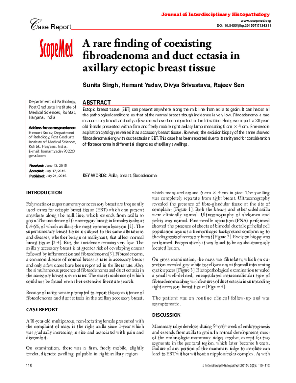 (PDF) A Rare Finding of Coexisting Fibroadenoma and Duct Ectasia in ...