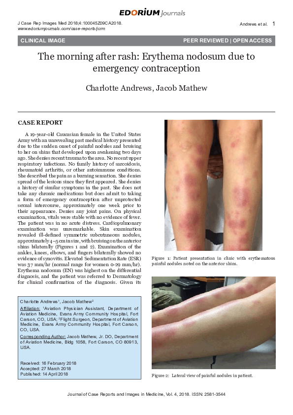 (PDF) The morning after rash: Erythema nodosum due to emergency ...
