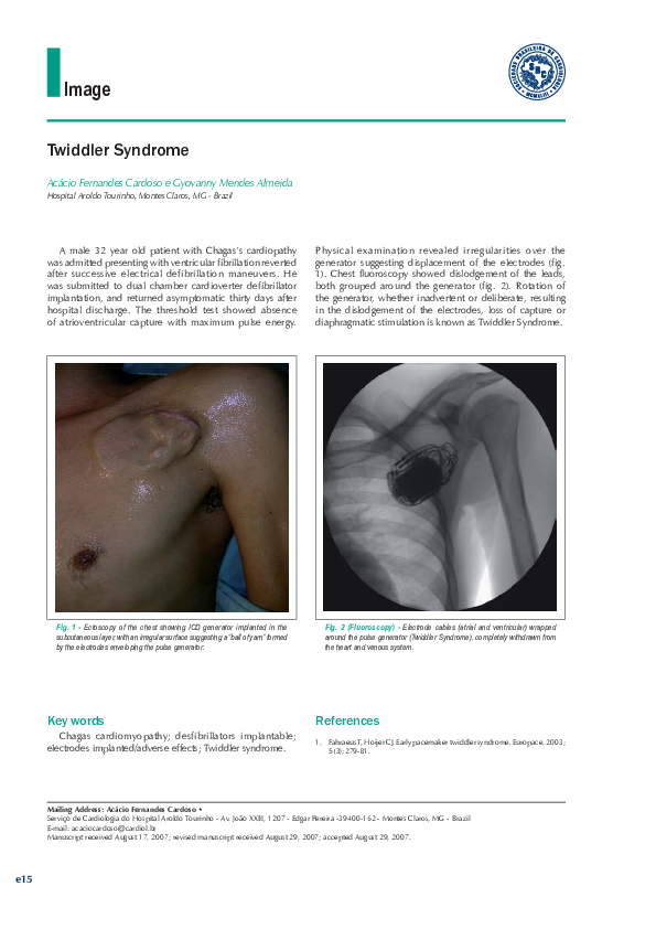 (PDF) Síndrome de Twiddler