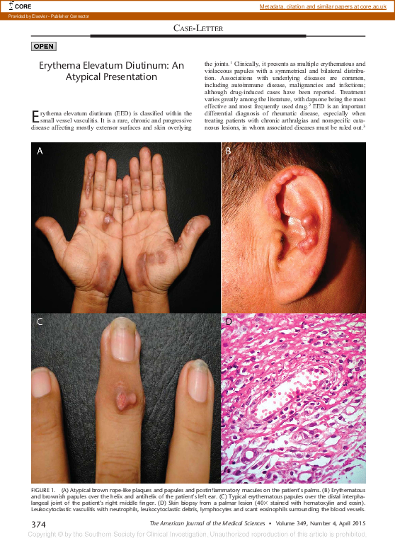 (PDF) Erythema Elevatum Diutinum: An Atypical Presentation