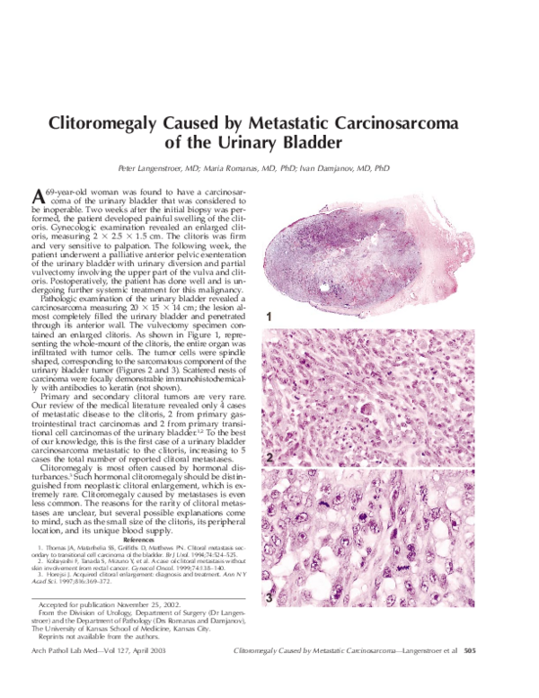 (PDF) Clitoromegaly caused by metastatic carcinosarcoma of the urinary ...