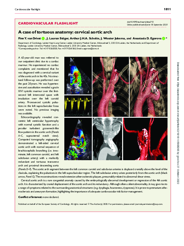 (PDF) A case of tortuous anatomy: cervical aortic arch