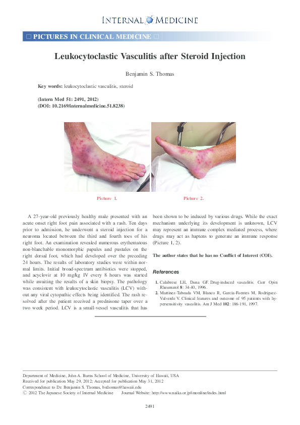 (PDF) Leukocytoclastic vasculitis after steroid injection Benjamin S